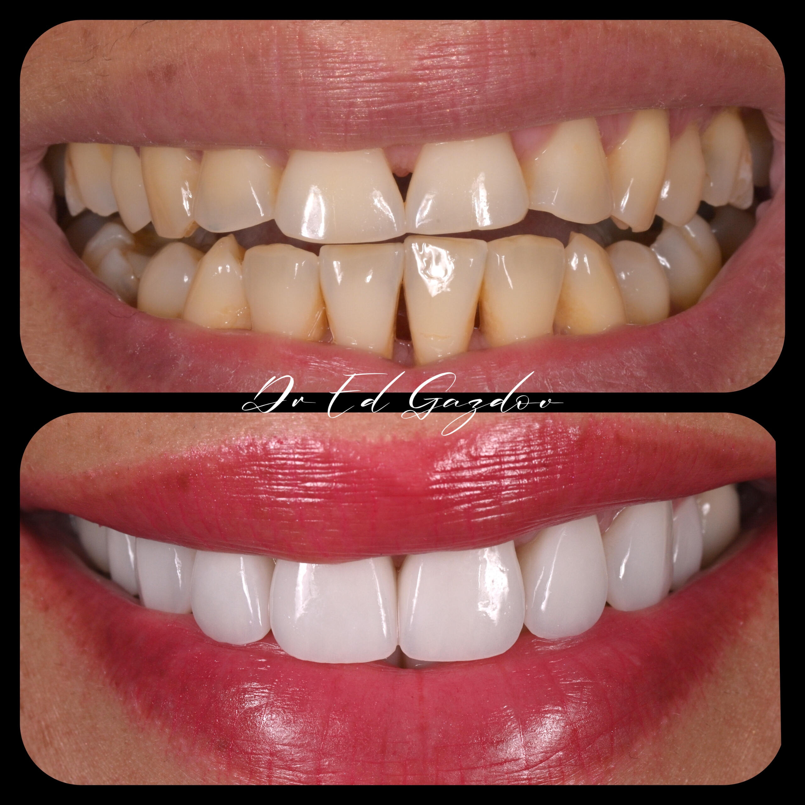 Veners фасети • alt="Before and after dental implants in Sofia" • alt="Smile makeover by Dr Gazdov" • alt="Cosmetic dental treatment in Bulgaria" • alt="Full smile rehabilitation with implants" • alt="Veneers and implants by Dr Eduard Gazdov" • alt="Dental implants before and after Sofia"