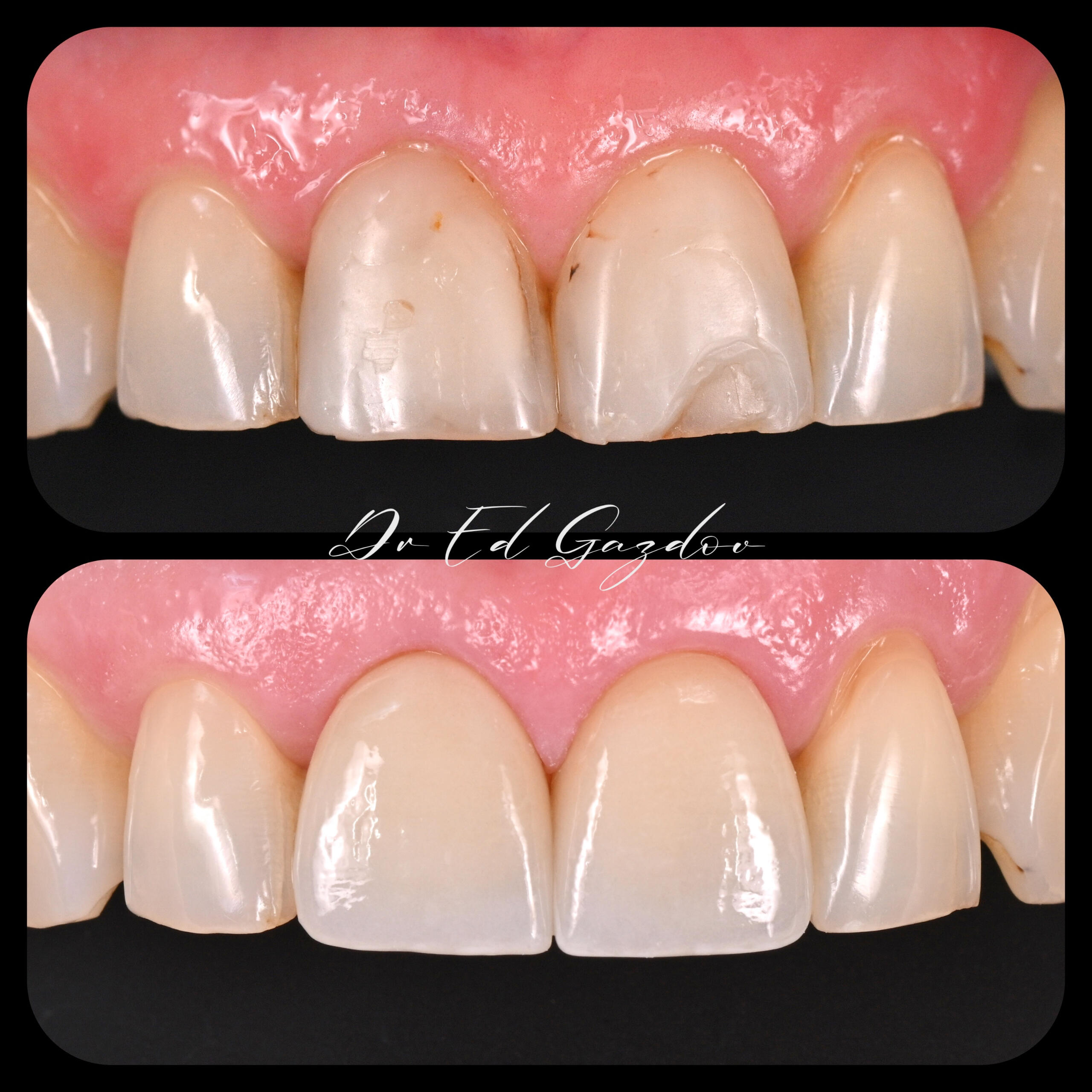 Veners фасети • alt="Before and after dental implants in Sofia" • alt="Smile makeover by Dr Gazdov" • alt="Cosmetic dental treatment in Bulgaria" • alt="Full smile rehabilitation with implants" • alt="Veneers and implants by Dr Eduard Gazdov" • alt="Dental implants before and after Sofia" винири, фасети