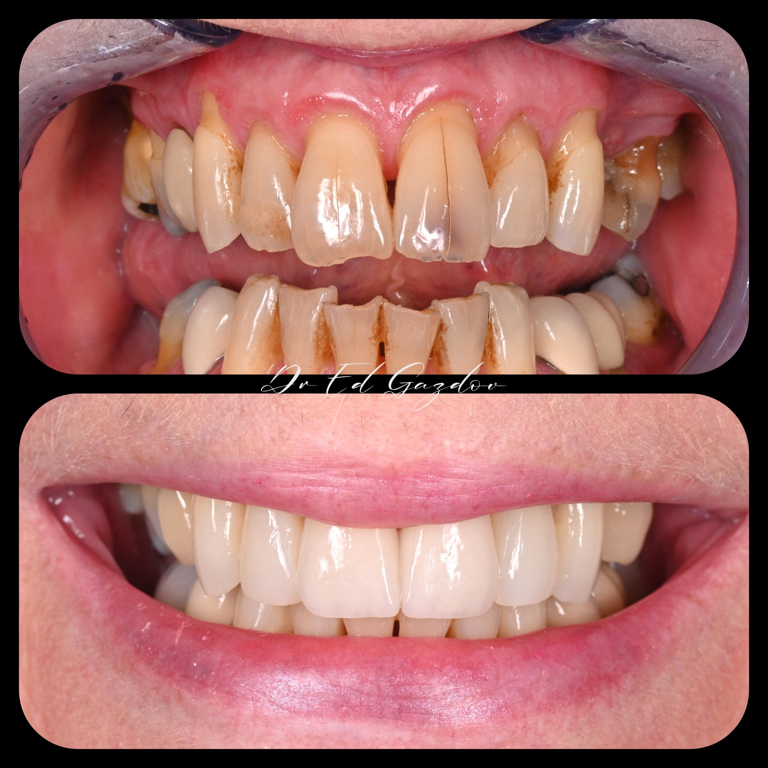 Veners фасети • alt="Before and after dental implants in Sofia" • alt="Smile makeover by Dr Gazdov" • alt="Cosmetic dental treatment in Bulgaria" • alt="Full smile rehabilitation with implants" • alt="Veneers and implants by Dr Eduard Gazdov" • alt="Dental implants before and after Sofia" Фасети, винири