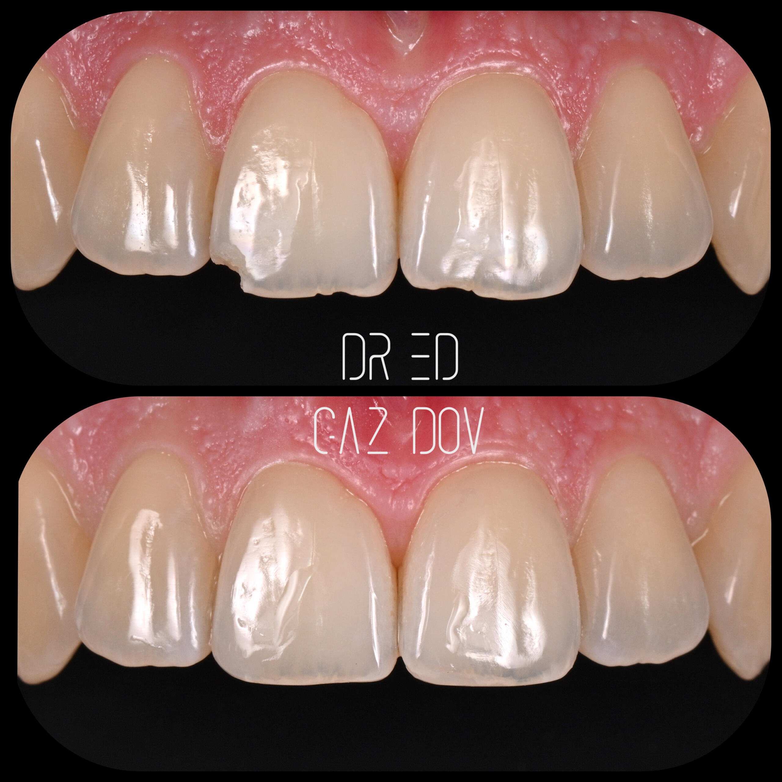 Composite repair of small enamel chip Cosmetic repair of small enamel chips using direct composite resin