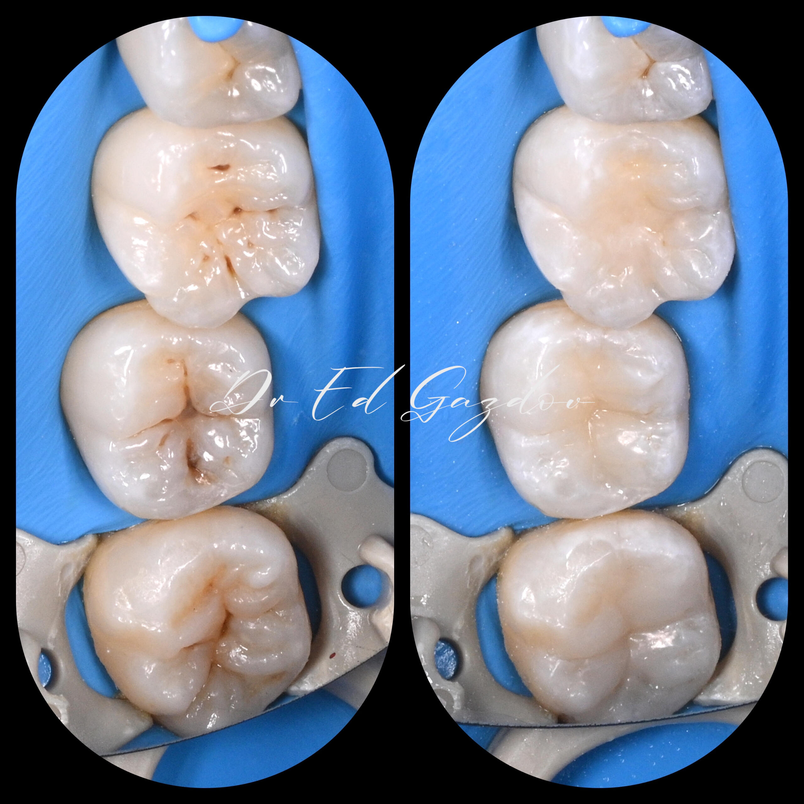 "Before and after tooth cavity treatment with composite filling Sofia" "before and after dental composite filling cavity treatment molars Sofia"