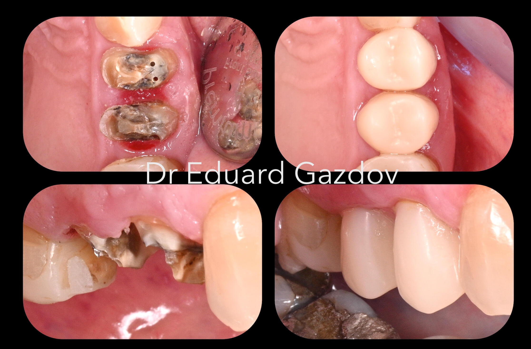 Before and after treatment of severely decayed and fractured teeth restored with advanced dentistry, preserving natural teeth and delaying the need for implants.