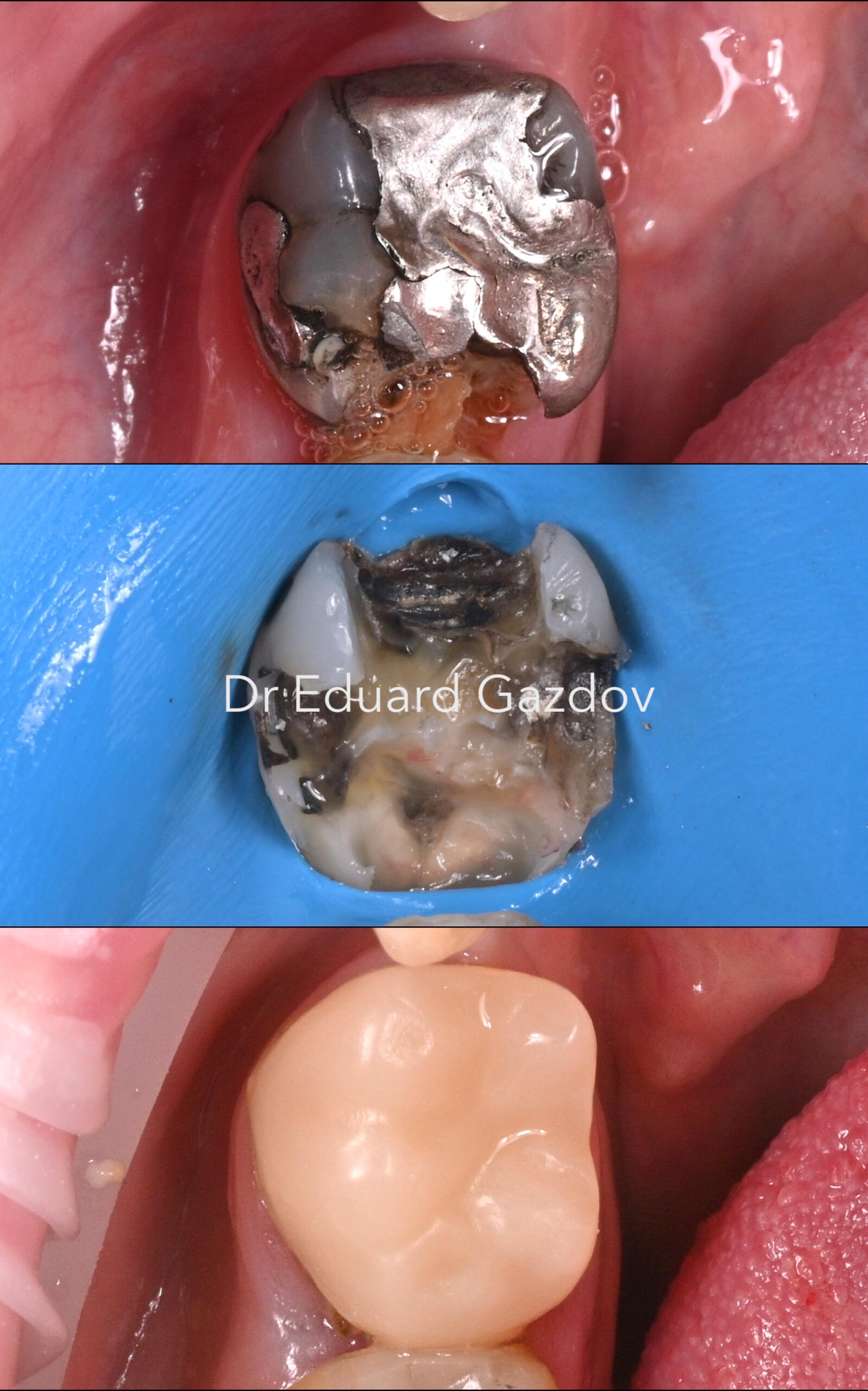 Single-visit ceramic crown created and fitted with digital CEREC system