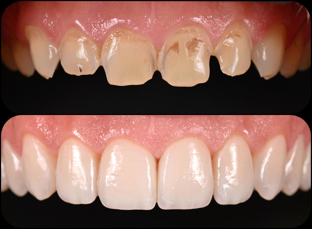 Before and after clinical photographs showing a smile restored with porcelain veneers to replace worn, fractured and discoloured upper front teeth, creating a natural, harmonious appearance.