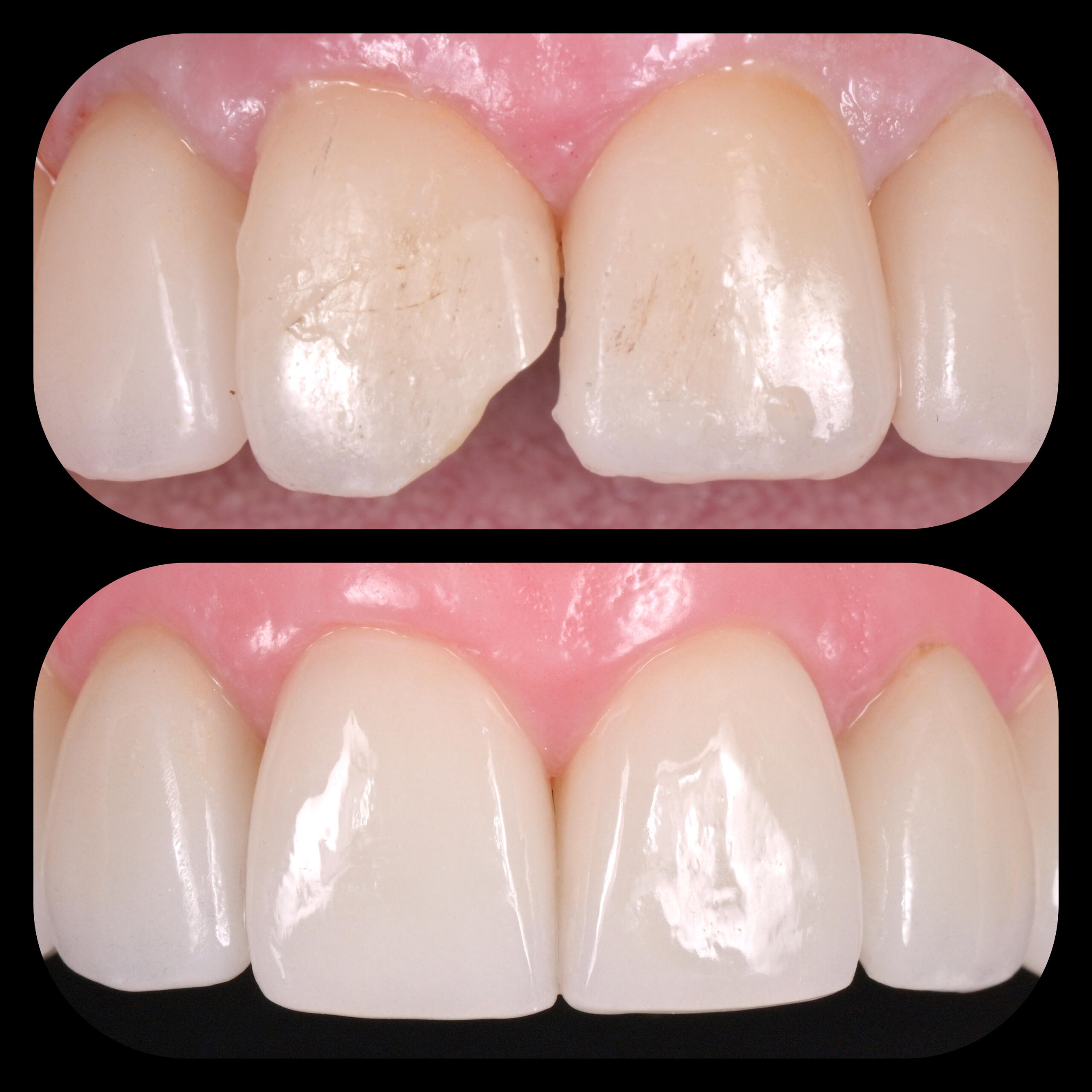 Veners фасети • alt="Before and after dental implants in Sofia" • alt="Smile makeover by Dr Gazdov" Faseti, винири, порцеланови корони