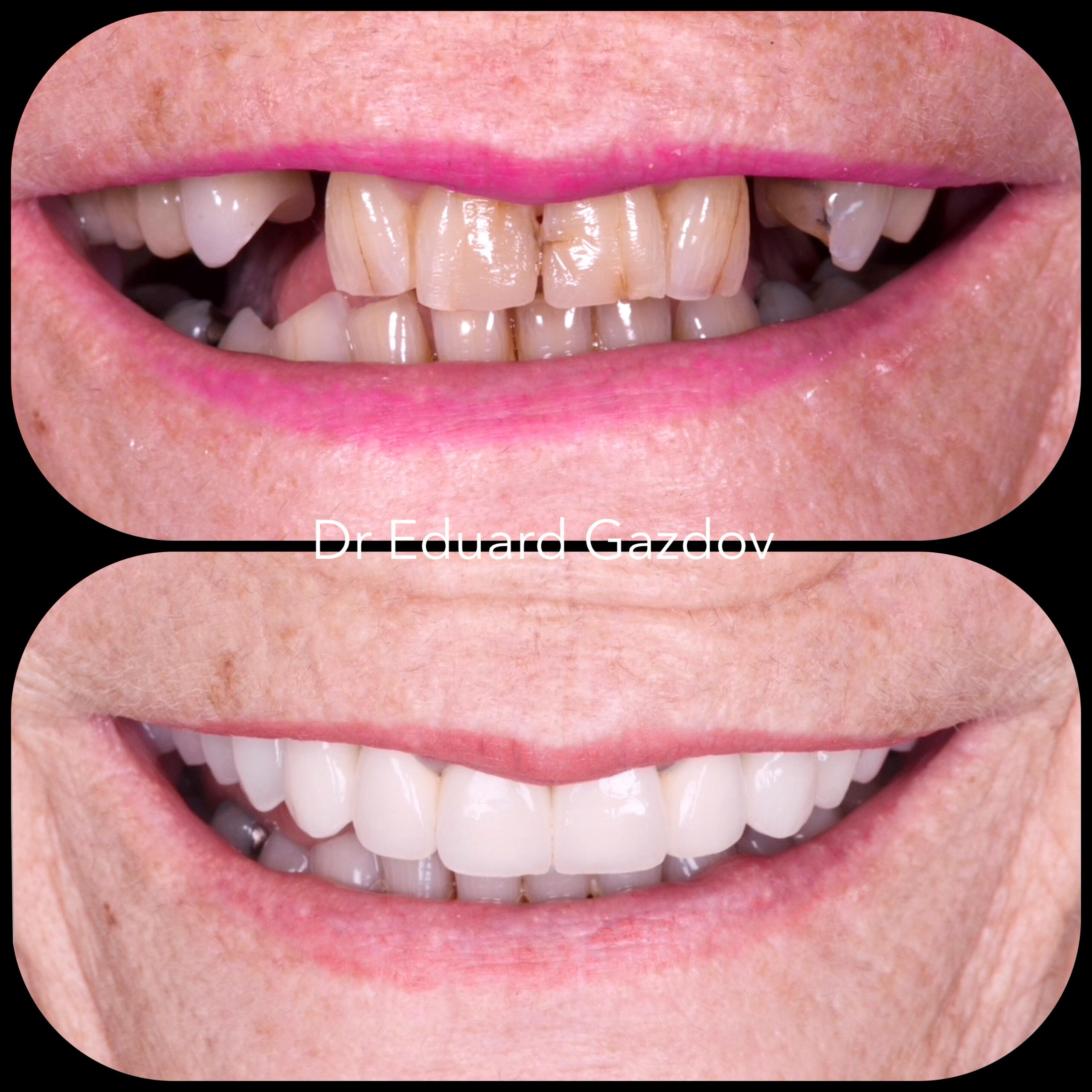• alt="Before and after dental implants in Sofia" • alt="Smile makeover by Dr Gazdov" • alt="Cosmetic dental treatment in Bulgaria" • alt="Full smile rehabilitation with implants" • alt="Veneers and implants by Dr Eduard Gazdov" • alt="Dental implants before and after Sofia"