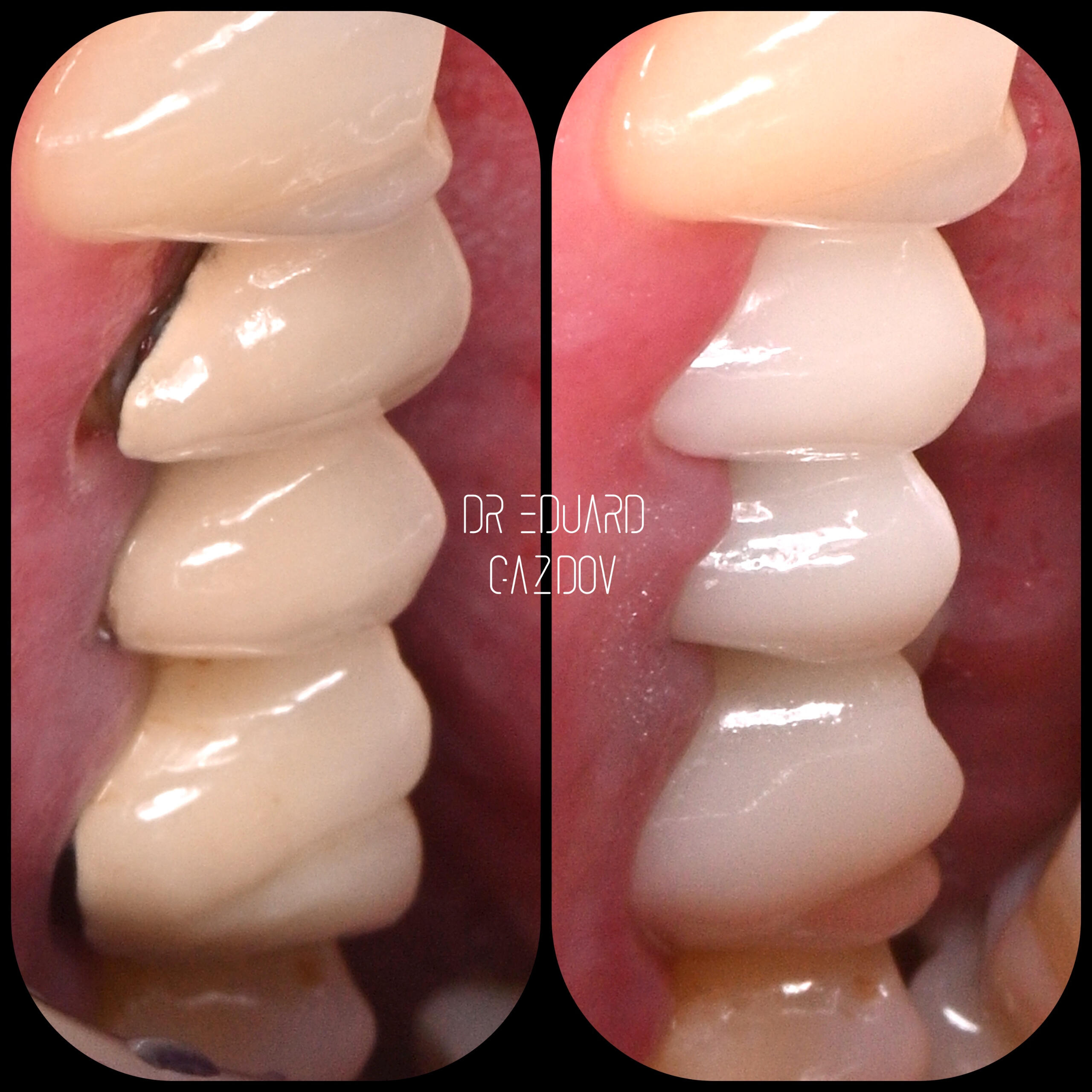 „Replacement of old crowns with dark margins with new porcelain crowns. Smile transformation completed in a single visit with CEREC – digitally designed and milled ceramic crowns.“
