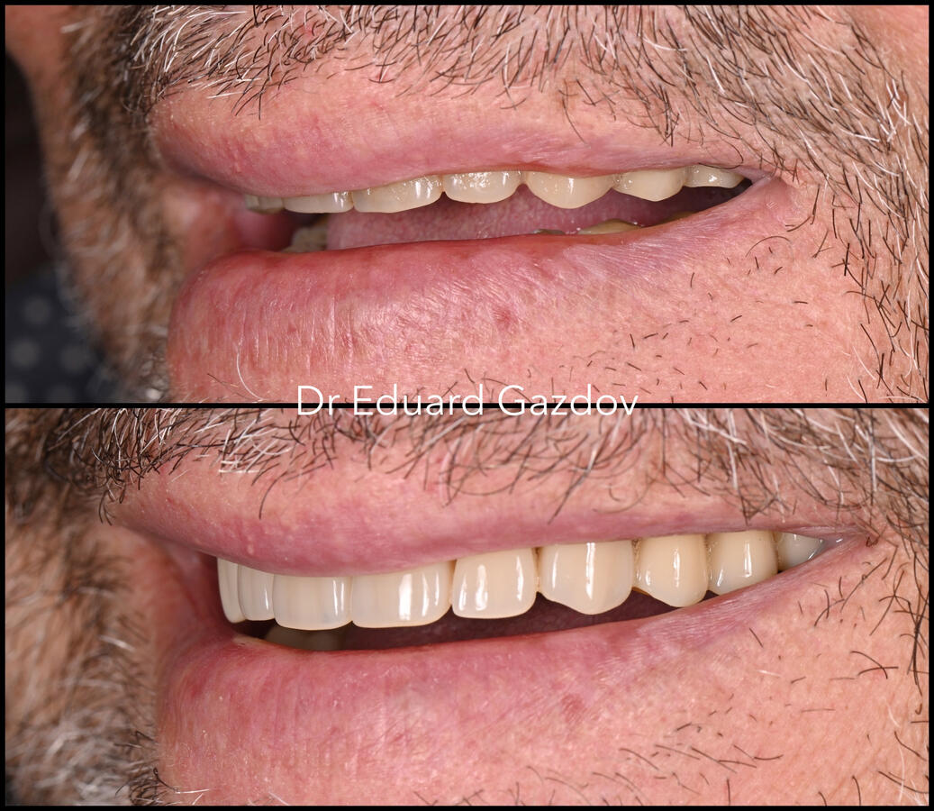 Before and after comparison of a natural-looking upper complete denture, showing improved tooth shape, colour, and lip support using the Swiss Denture Concept.