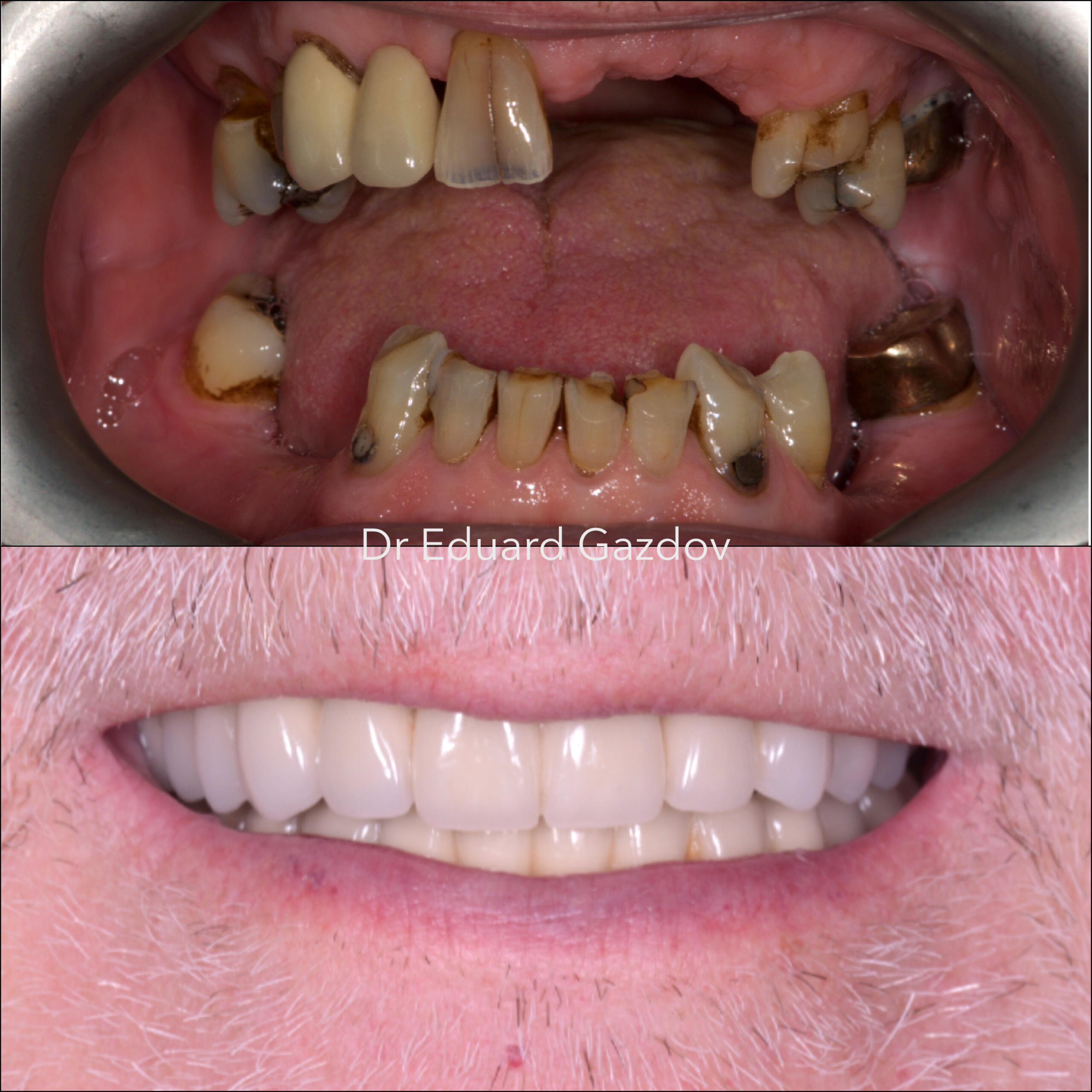 • alt="Before and after dental implants in Sofia" • alt="Smile makeover by Dr Gazdov" • alt="Cosmetic dental treatment in Bulgaria" • alt="Full smile rehabilitation with implants" • alt="Veneers and implants by Dr Eduard Gazdov" • alt="Dental implants before and after Sofia