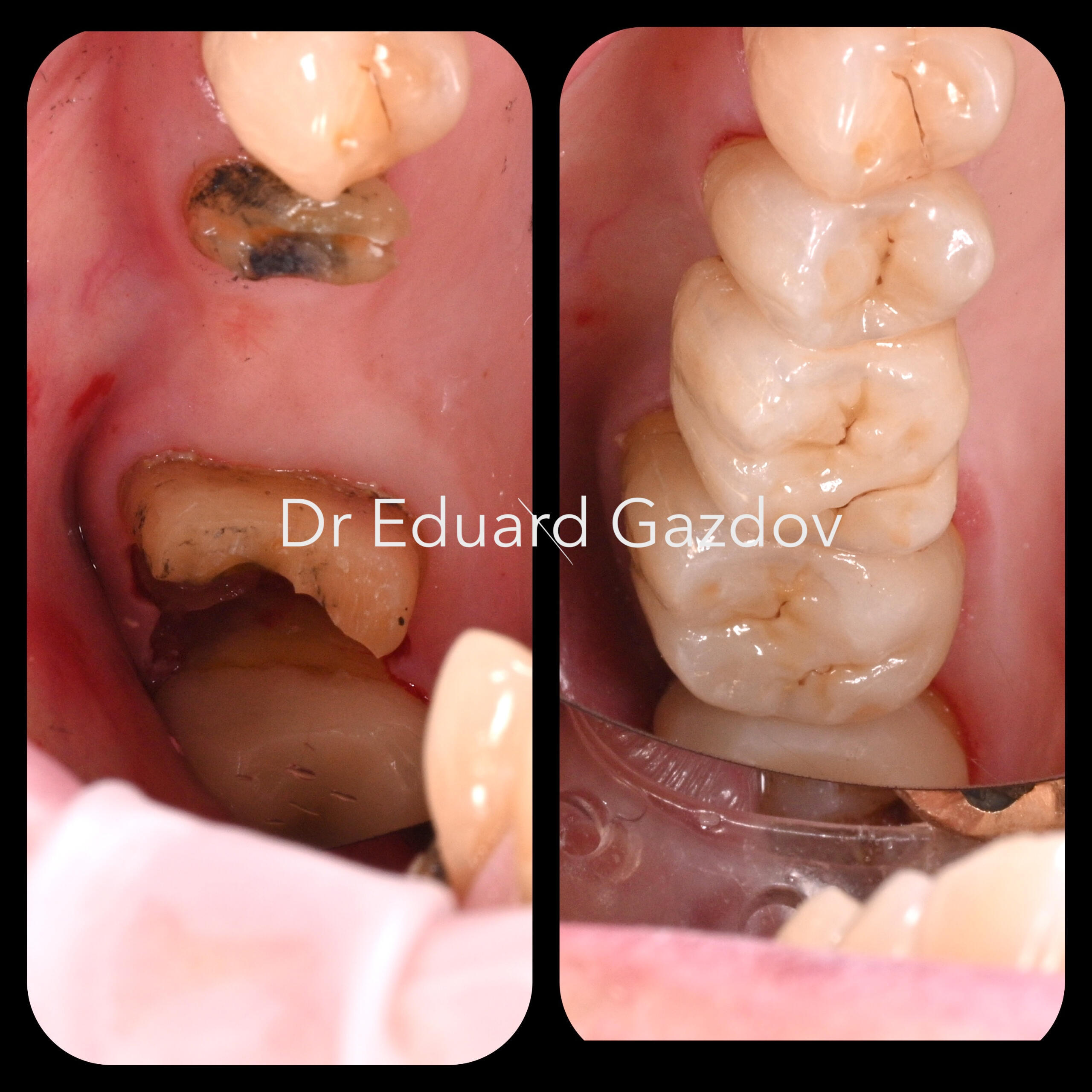 Natural-looking fixed dental bridge Фиксиран мост за заместване на липсващи зъби с естествена естетика