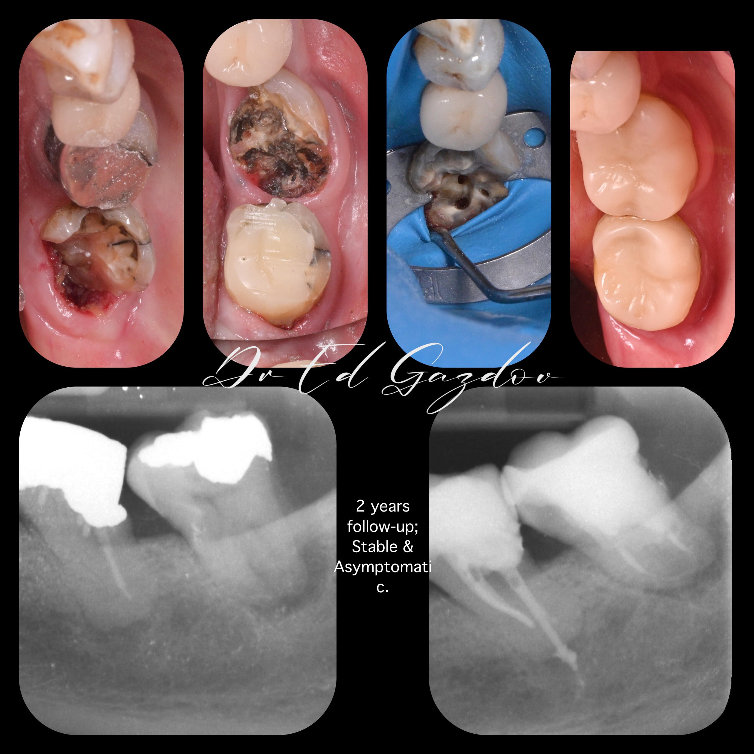 Before and after treatment of severely decayed molar teeth using root canal therapy and full-coverage crowns. Two-year follow-up shows stable, asymptomatic results.