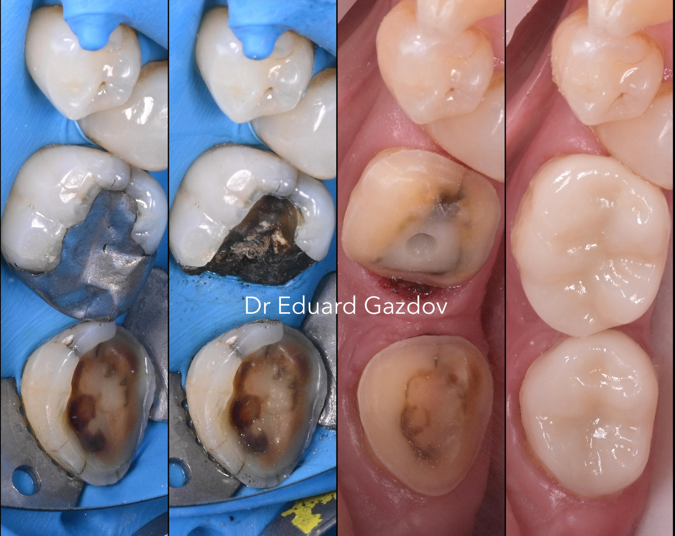 Single-visit ceramic crown created and fitted with digital CEREC system