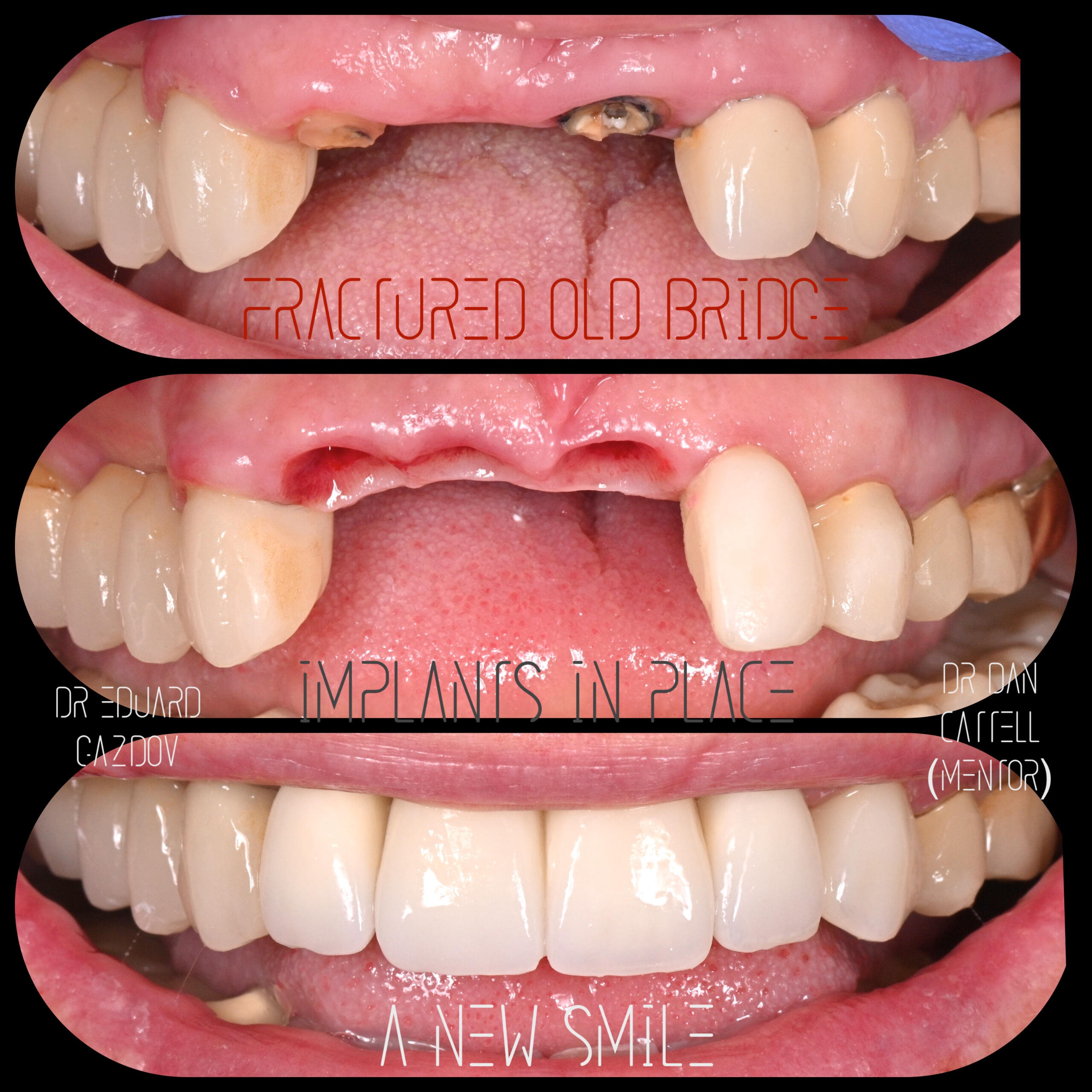 • alt="Cosmetic dental treatment in Bulgaria" • alt="Full smile rehabilitation with implants" • alt="Veneers and implants by Dr Eduard Gazdov" • alt="Dental implants before and after Sofia" Импланти