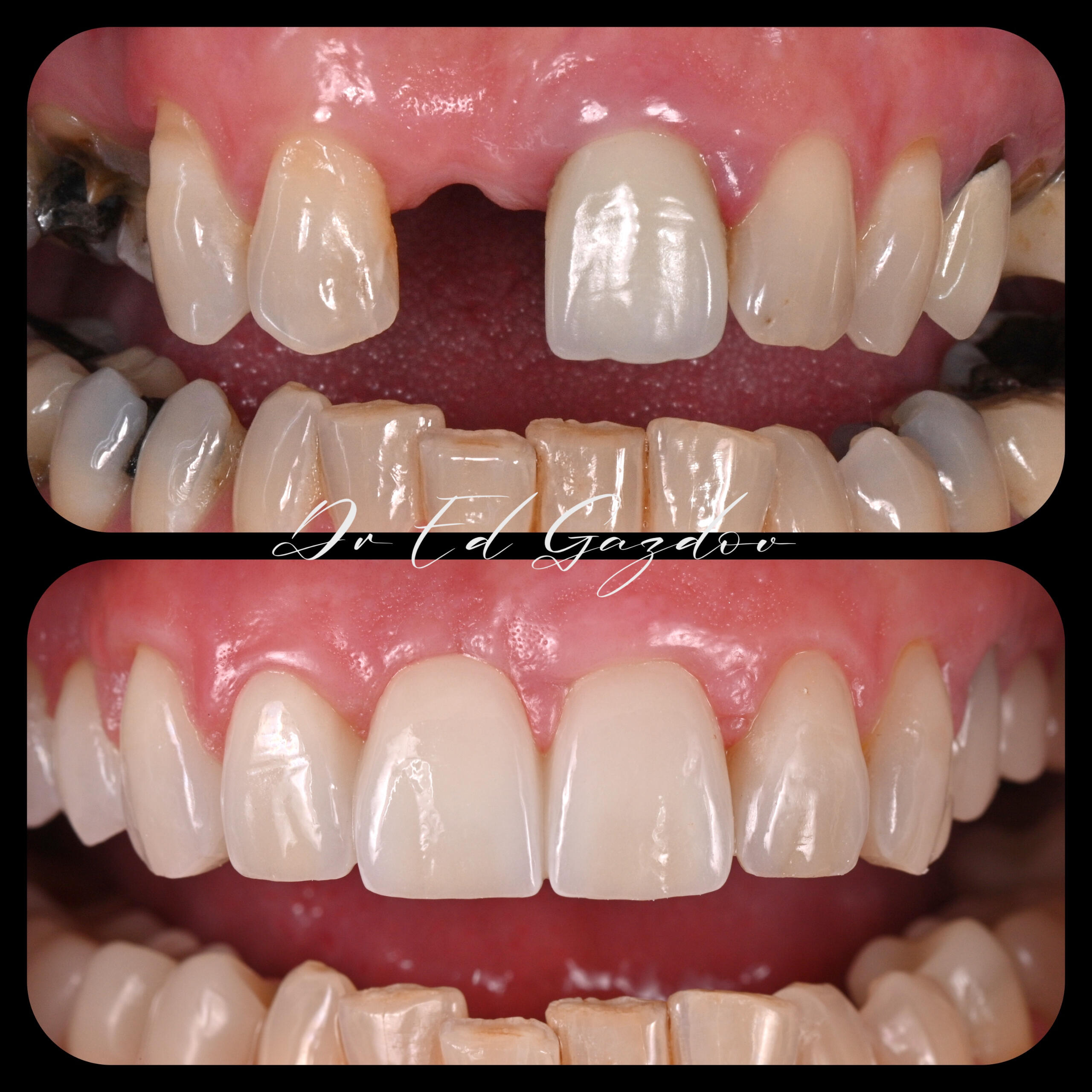Before and after full smile makeover with porcelain crowns, veneers, and gum contouring. Replacement of old restorations.