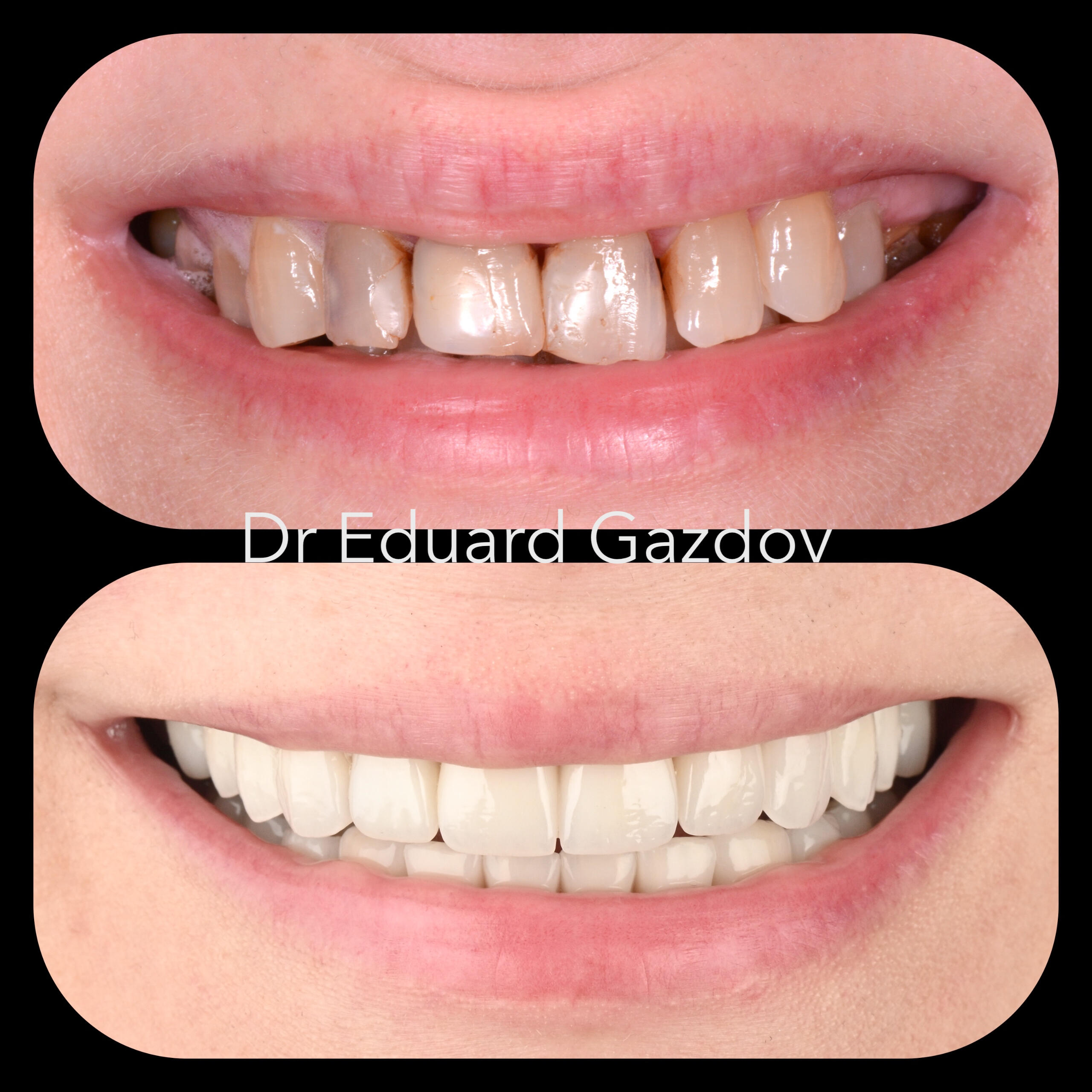 "before and after full smile makeover dental implants porcelain zirconia crowns Sofia"