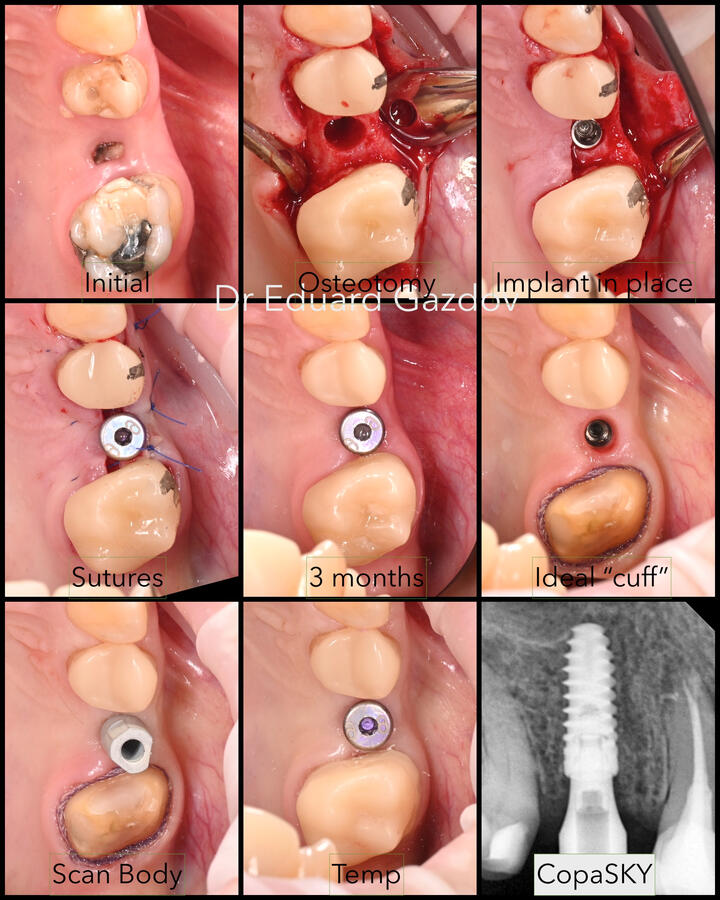 Series of clinical images demonstrating guided dental implant placement: positioning of the surgical guide, drilling sequence, implant insertion, and verification.