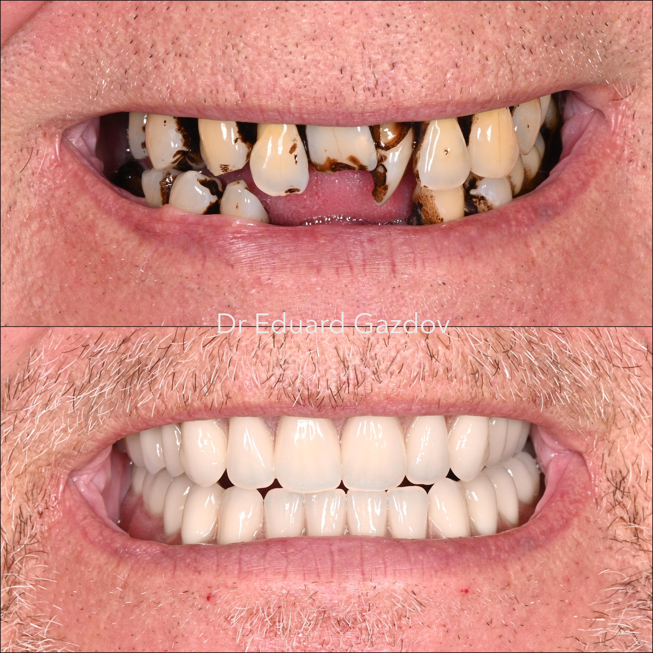 • alt="Before and after dental implants in Sofia" • alt="Smile makeover by Dr Gazdov" Импланти, дентални импланти, implants, dental implants • alt="Cosmetic dental treatment in Bulgaria" • alt="Full smile rehabilitation with implants" • alt="Veneers and implants by Dr Eduard Gazdov" • alt="Dental implants before and after Sofia"