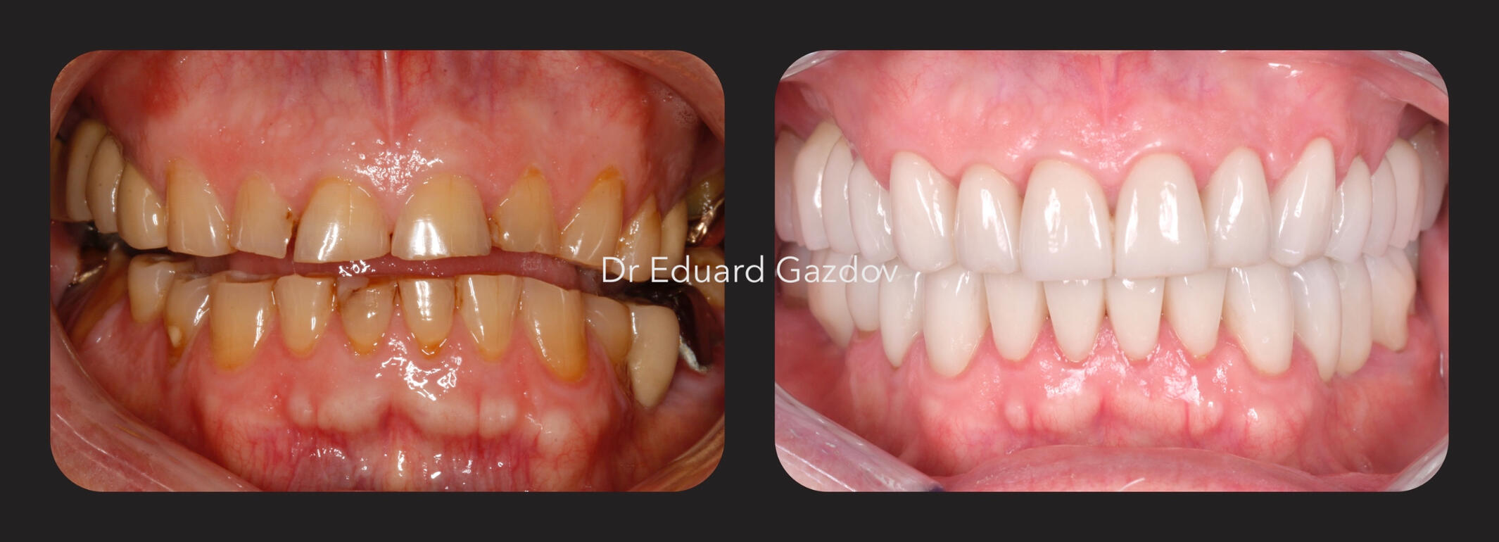alt="Before and after dental implants in Sofia" • alt="Smile makeover by Dr Gazdov All-ceramic crowns replacing old restorations Before and after smile makeover with ceramic veneers for front teeth • alt="Cosmetic dental treatment in Bulgaria" • alt="Full smile rehabilitation with implants" • alt="Veneers and implants by Dr Eduard Gazdov" • alt="Dental implants before and after Sofi